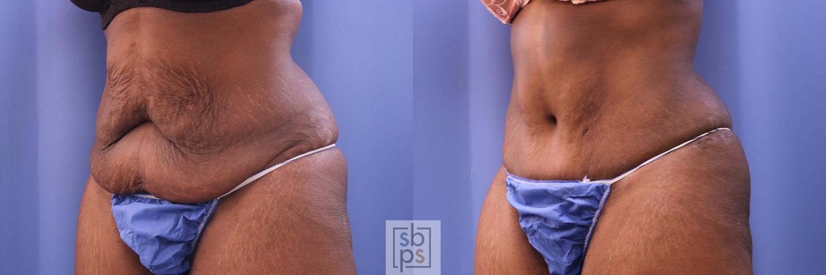 Before & After Liposuction Case 475 Left Oblique View in Torrance & Los Angeles, CA, CA