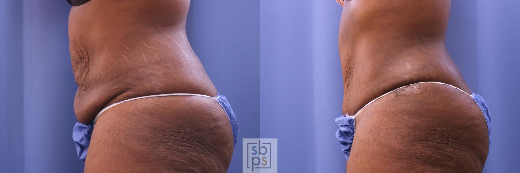 Before & After Liposuction Case 475 Left Side View in Torrance & Los Angeles, CA, CA