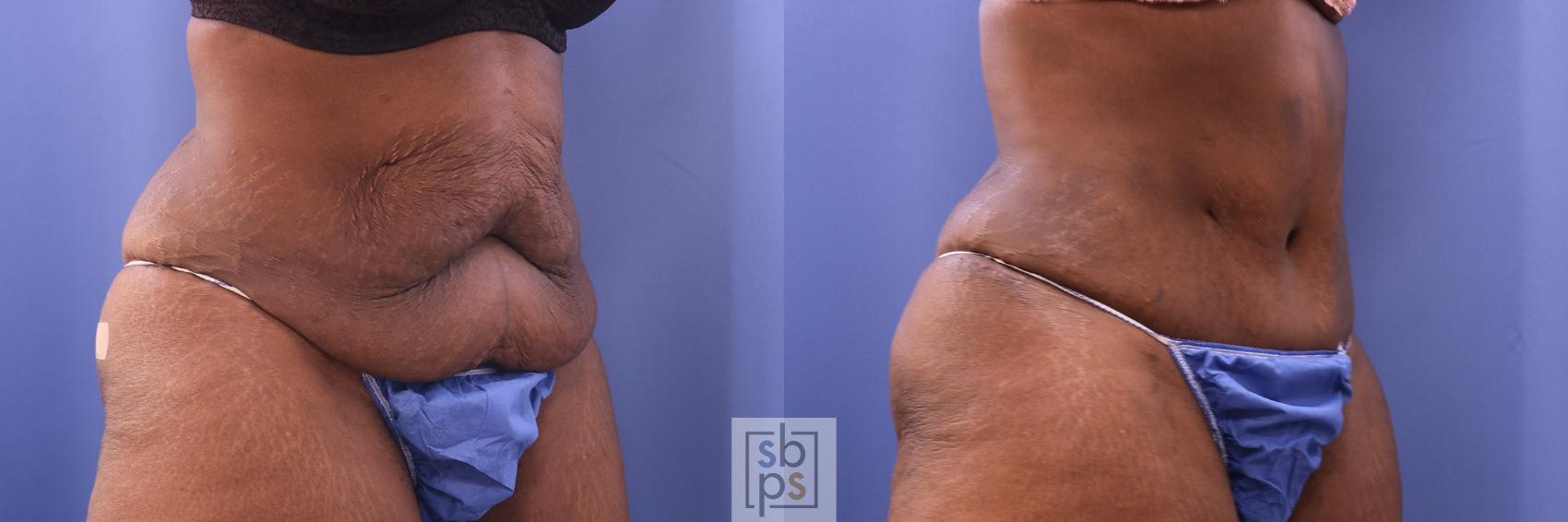 Before & After Liposuction Case 475 Right Oblique View in Torrance & Los Angeles, CA, CA