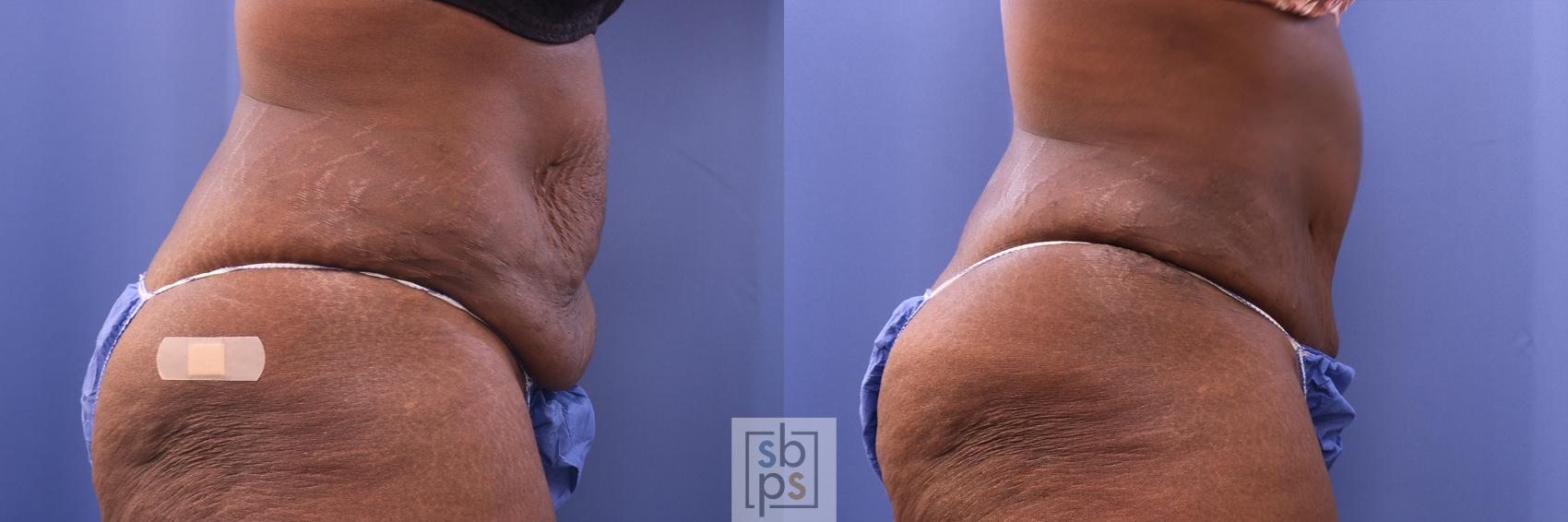 Before & After Liposuction Case 475 Right Side View in Torrance & Los Angeles, CA, CA