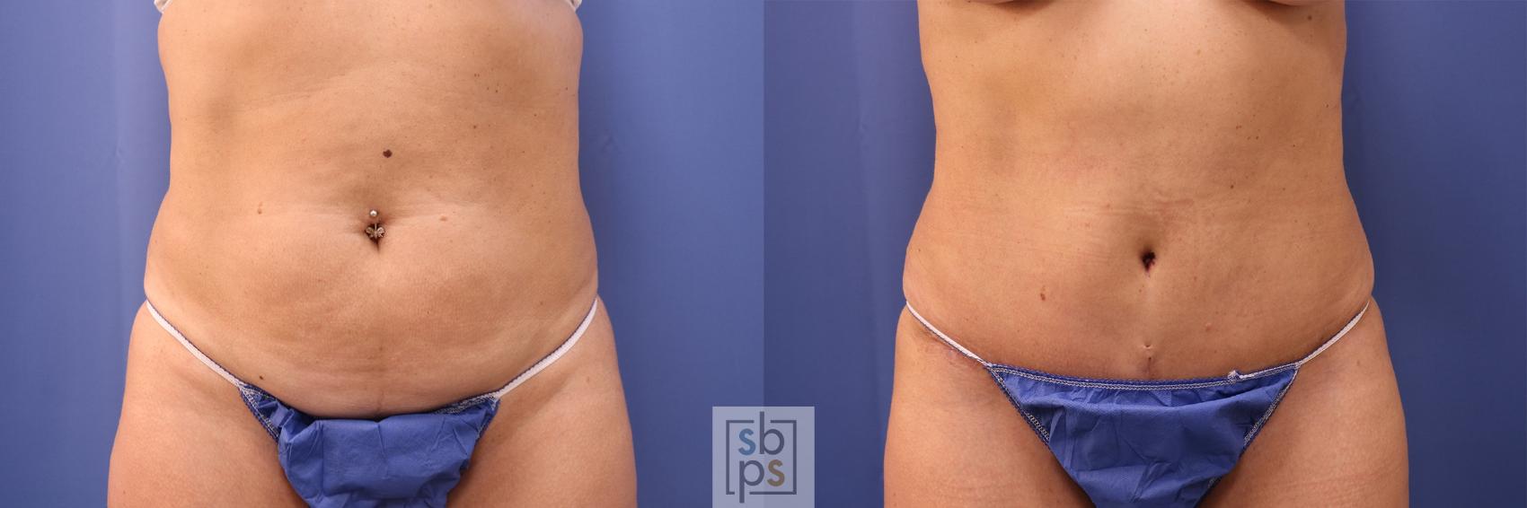 Before & After Tummy Tuck Case 477 Front View in Torrance, CA