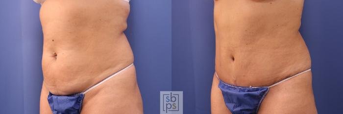 Before & After Tummy Tuck Case 477 Left Oblique View in Torrance, CA