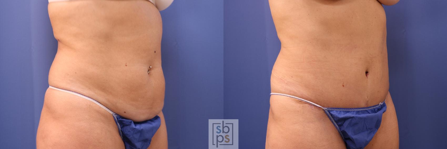 Before & After Tummy Tuck Case 477 Right Oblique View in Torrance & Los Angeles, CA, CA