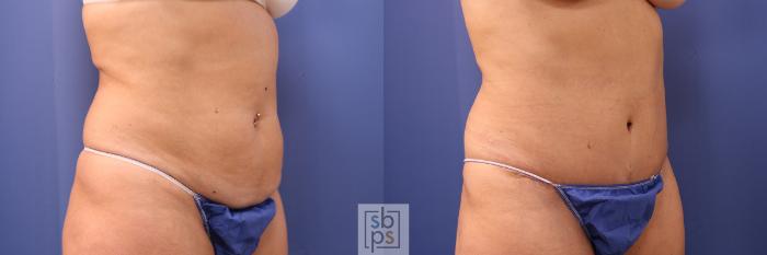 Before & After Tummy Tuck Case 477 Right Oblique View in Torrance, CA