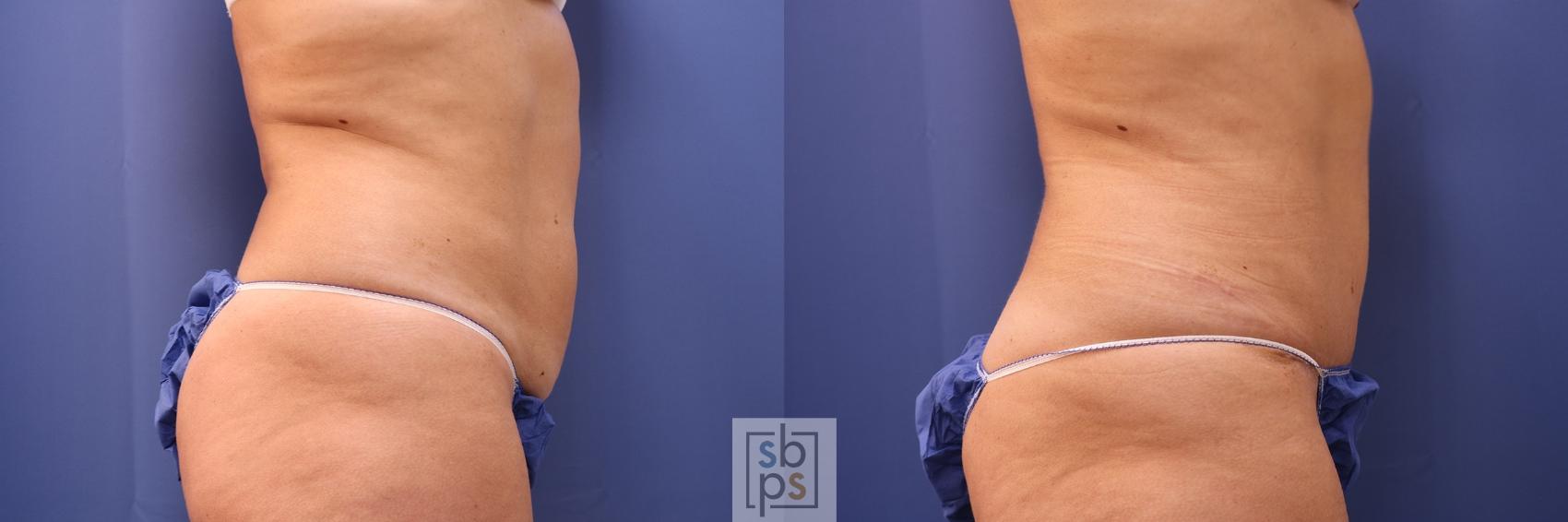 Before & After Tummy Tuck Case 477 Right Side View in Torrance & Los Angeles, CA, CA