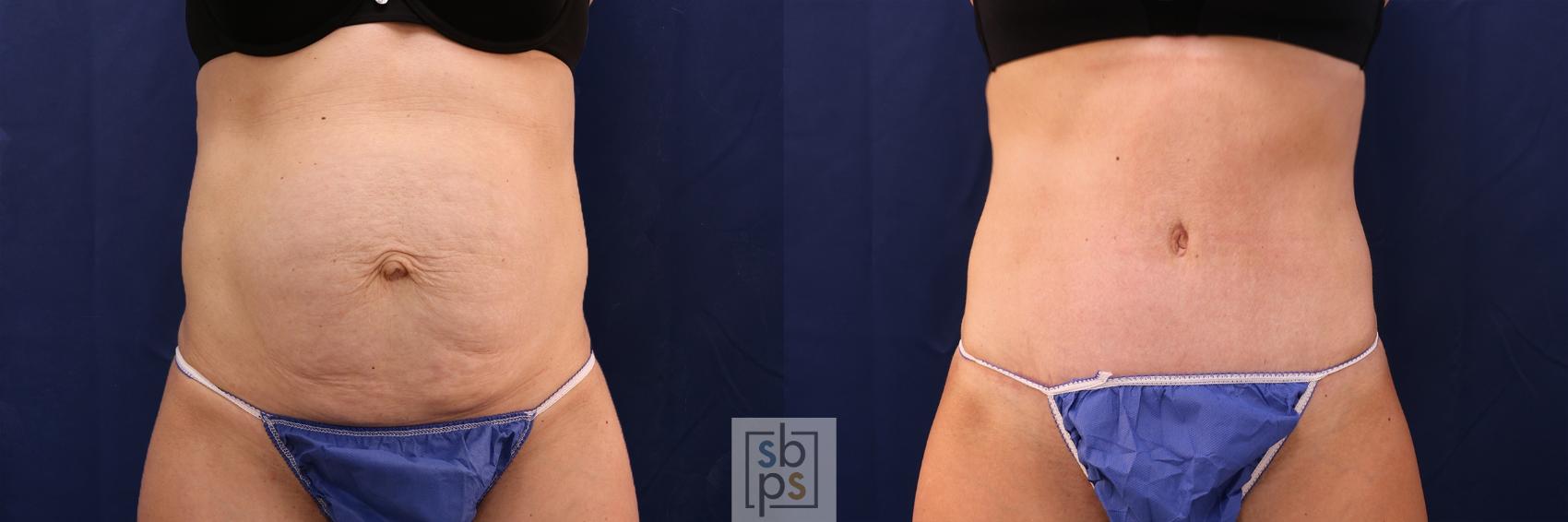 Before & After Tummy Tuck Case 479 Front View in Torrance, CA
