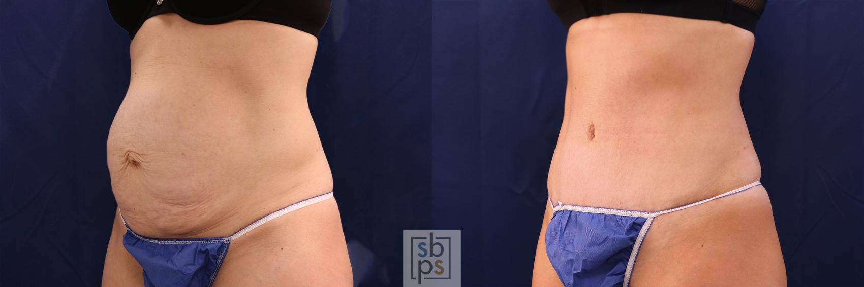 Before & After Tummy Tuck Case 479 Left Oblique View in Torrance & Los Angeles, CA, CA