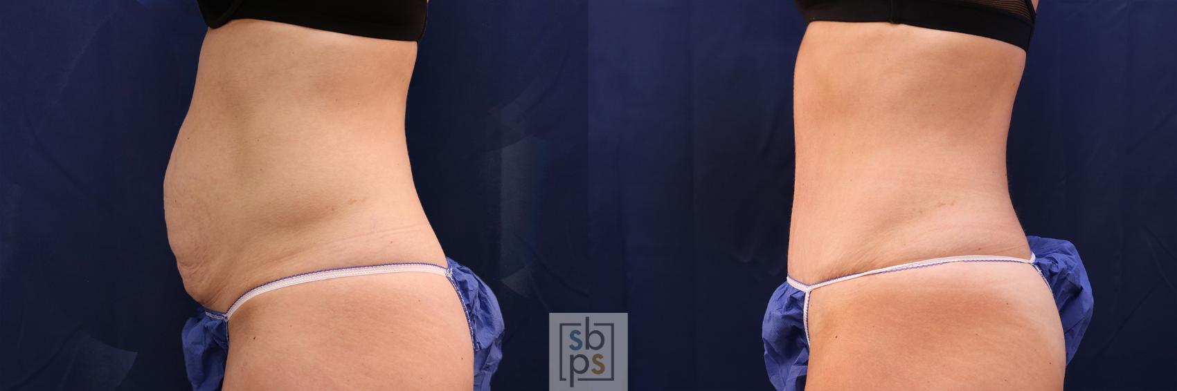 Before & After Tummy Tuck Case 479 Left Side View in Torrance & Los Angeles, CA, CA