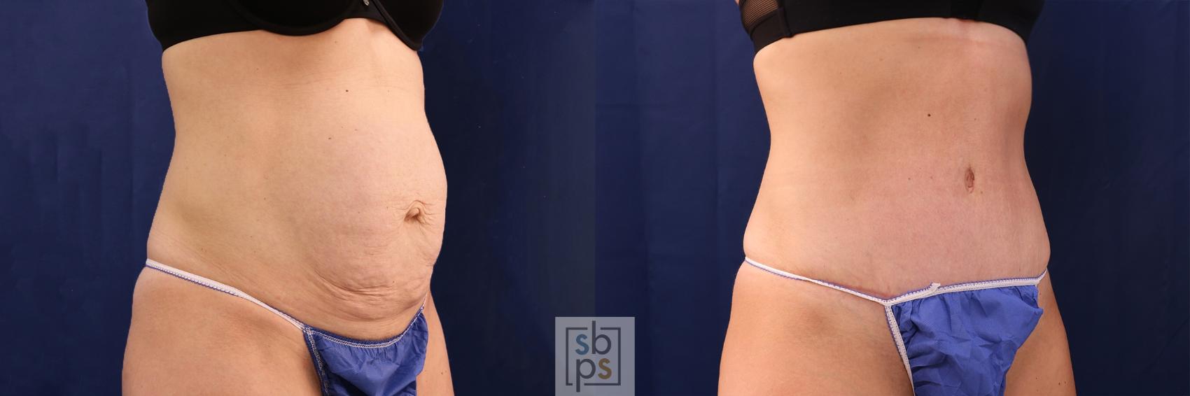 Before & After Tummy Tuck Case 479 Right Oblique View in Torrance & Los Angeles, CA, CA