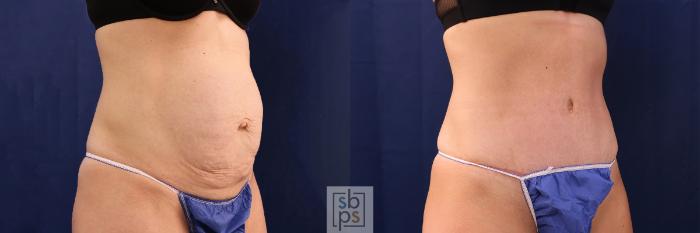 Before & After Tummy Tuck Case 479 Right Oblique View in Torrance, CA