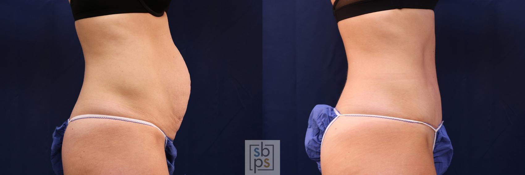 Before & After Tummy Tuck Case 479 Right Side View in Torrance & Los Angeles, CA, CA