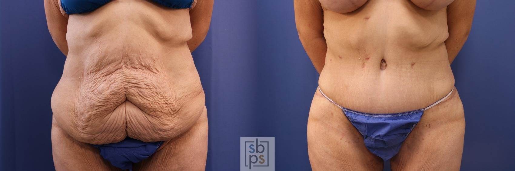 Before & After Tummy Tuck Case 483 Front View in Torrance, CA