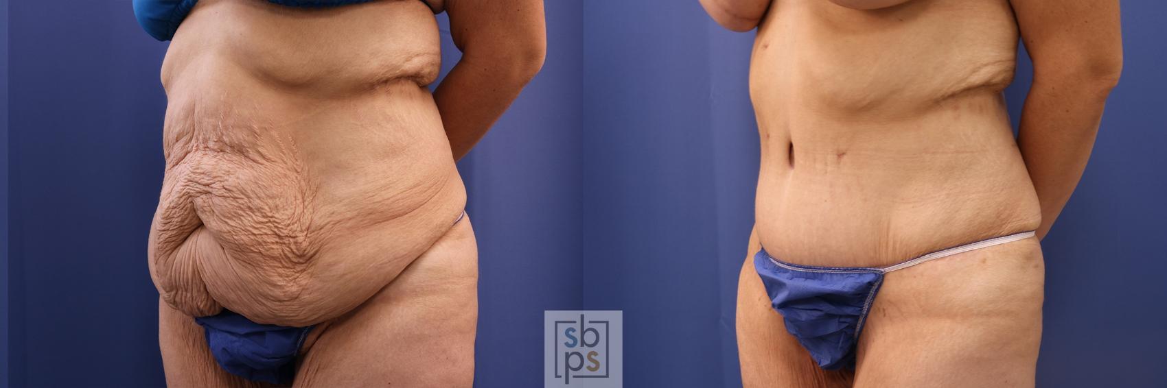 Before & After Tummy Tuck Case 483 Left Oblique View in Torrance & Los Angeles, CA, CA