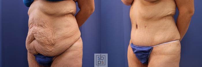 Before & After Tummy Tuck Case 483 Left Oblique View in Torrance, CA