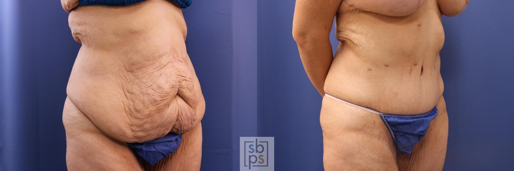 Before & After Tummy Tuck Case 483 Right Oblique View in Torrance & Los Angeles, CA, CA