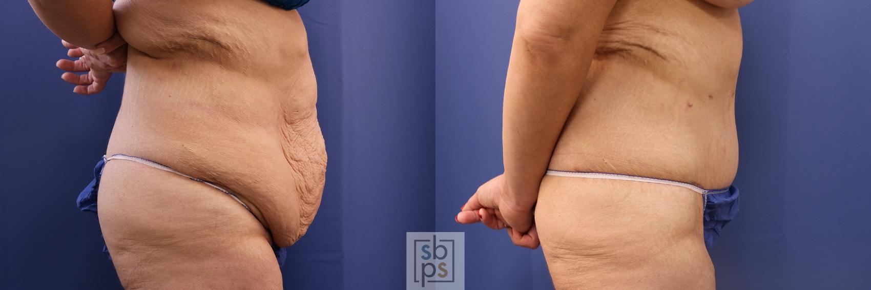 Before & After Tummy Tuck Case 483 Right Side View in Torrance & Los Angeles, CA, CA