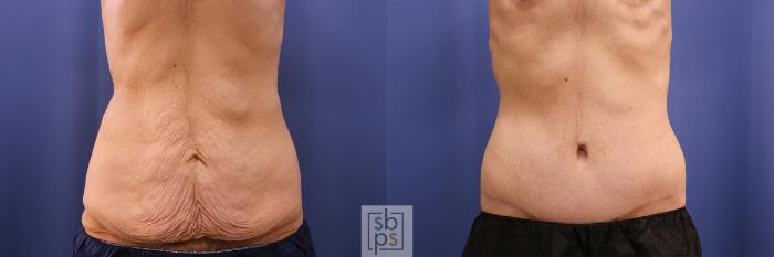 Before & After Tummy Tuck Case 486 Front View in Torrance, CA