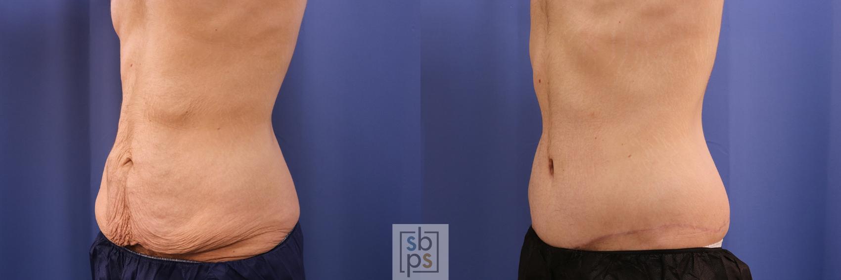 Before & After Tummy Tuck Case 486 Left Oblique View in Torrance & Los Angeles, CA, CA