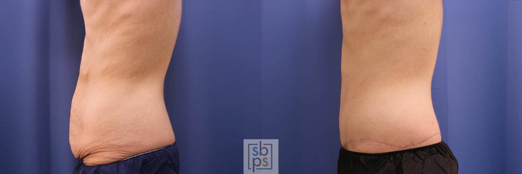 Before & After Tummy Tuck Case 486 Left Side View in Torrance & Los Angeles, CA, CA