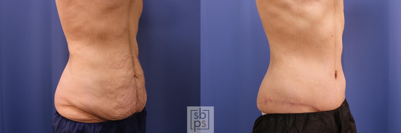 Before & After Tummy Tuck Case 486 Right Oblique View in Torrance & Los Angeles, CA, CA