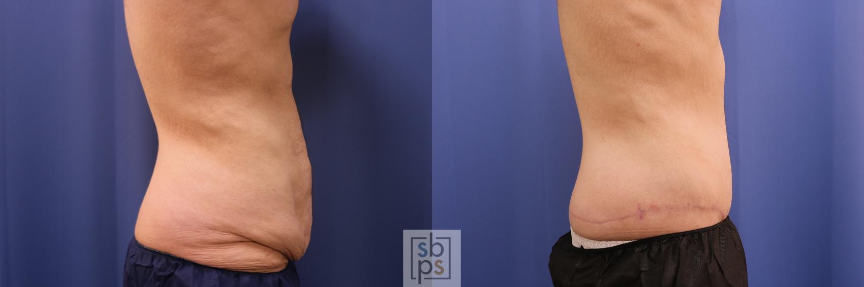 Before & After Tummy Tuck Case 486 Right Side View in Torrance & Los Angeles, CA, CA