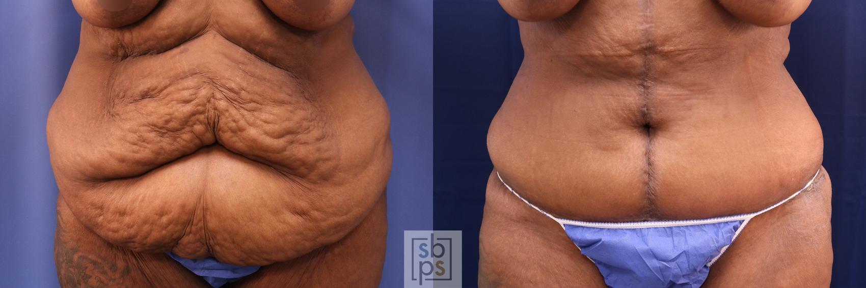 Before & After Tummy Tuck Case 490 Front View in Torrance, CA