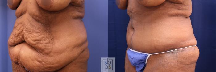 Before & After Tummy Tuck Case 490 Left Oblique View in Torrance, CA