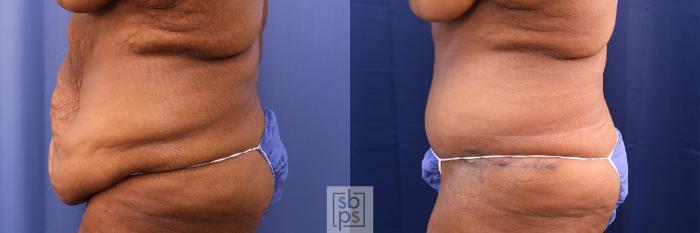 Before & After Tummy Tuck Case 490 Left Side View in Torrance, CA