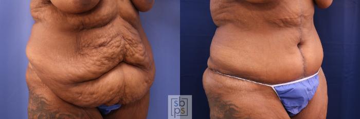 Before & After Tummy Tuck Case 490 Right Oblique View in Torrance, CA