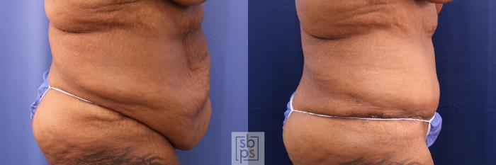 Before & After Tummy Tuck Case 490 Right Side View in Torrance, CA