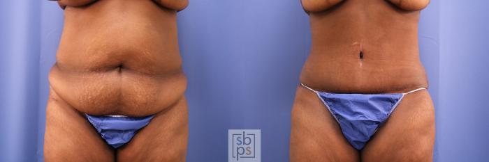 Before & After Tummy Tuck Case 492 Front View in Torrance, CA