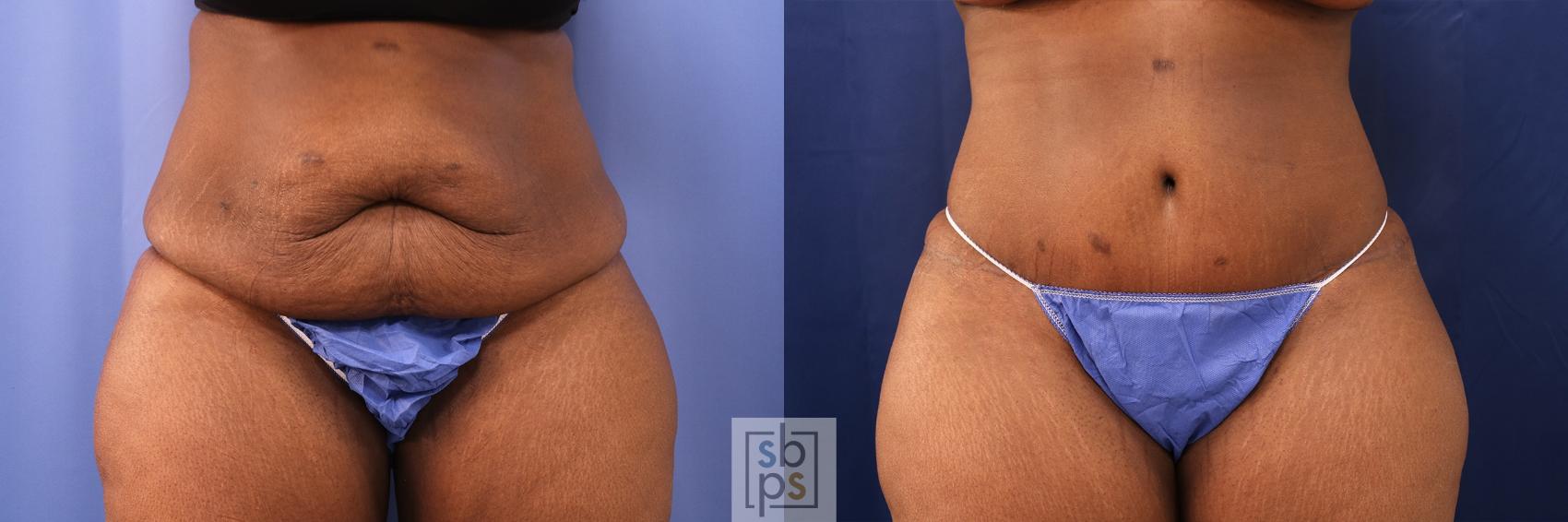 Before & After Tummy Tuck Case 497 Front View in Torrance, CA