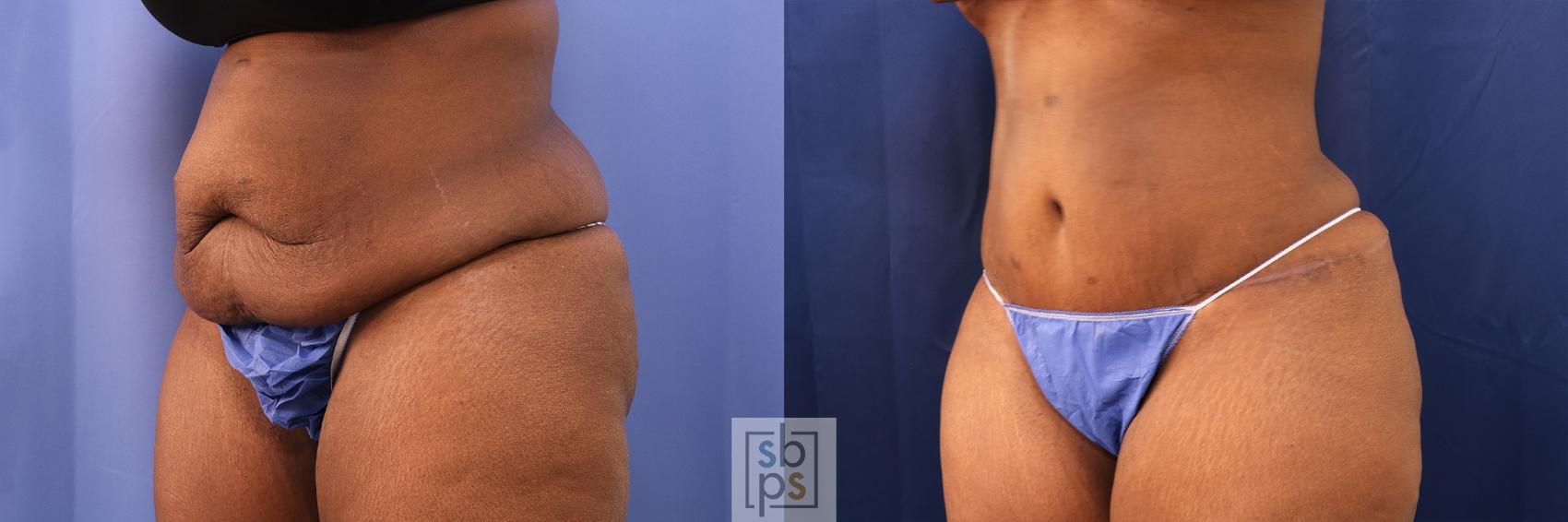 Before & After Tummy Tuck Case 497 Left Oblique View in Los Angeles, Torrance & Long Beach, CA