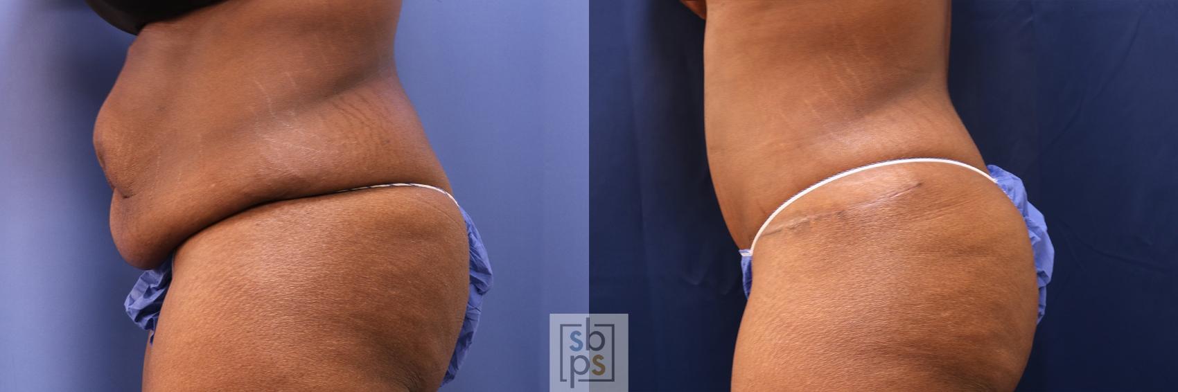 Before & After Tummy Tuck Case 497 Left Side View in Los Angeles, Torrance & Long Beach, CA