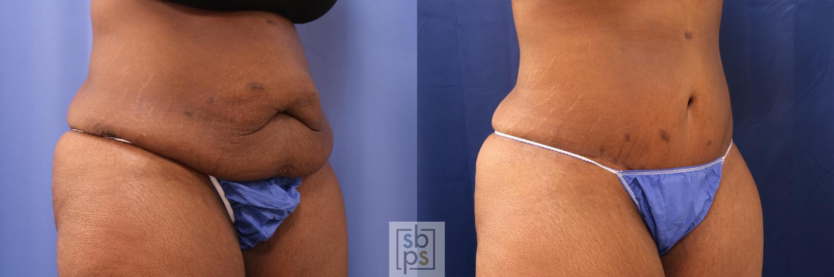 Before & After Tummy Tuck Case 497 Right Oblique View in Los Angeles, Torrance & Long Beach, CA