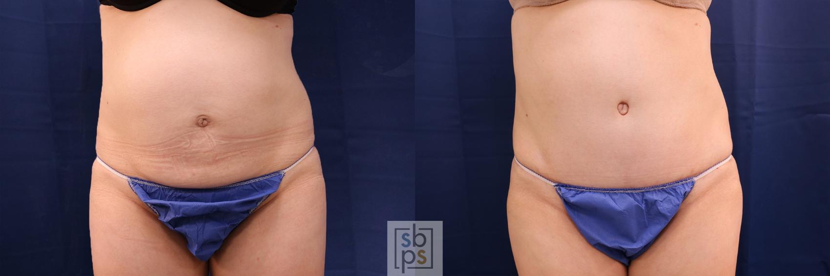 Before & After Tummy Tuck Case 505 Front View in Torrance, CA