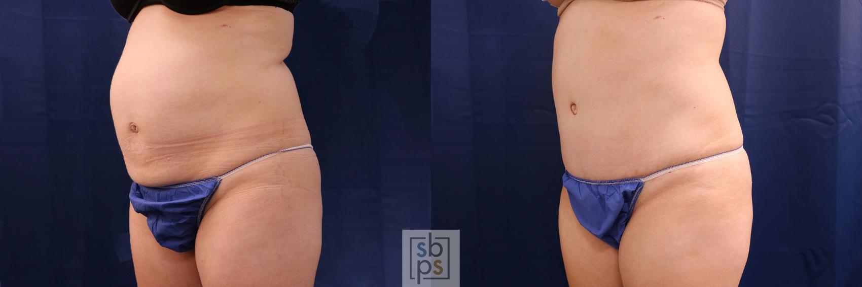 Before & After Tummy Tuck Case 505 Left Oblique View in Torrance & Los Angeles, CA, CA