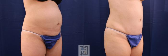 Before & After Tummy Tuck Case 505 Right Oblique View in Torrance, CA
