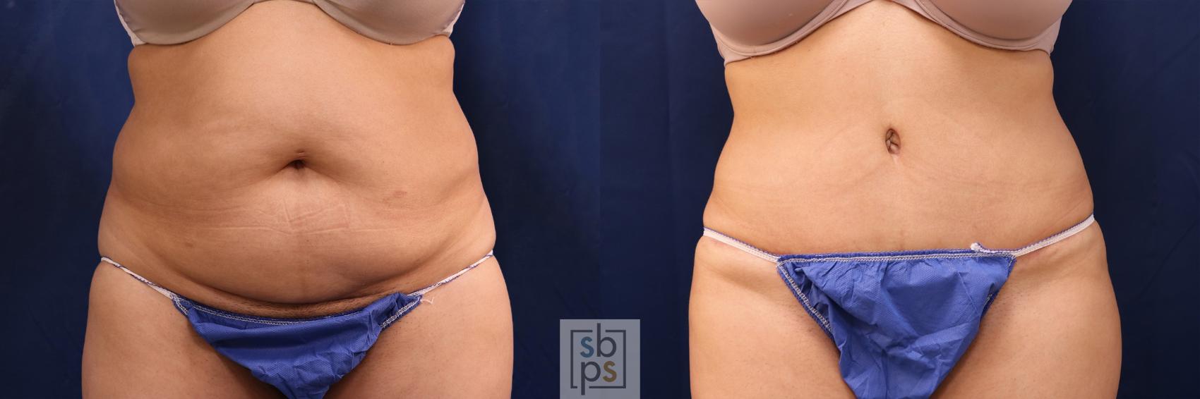 Before & After Tummy Tuck Case 507 Front View in Torrance, CA