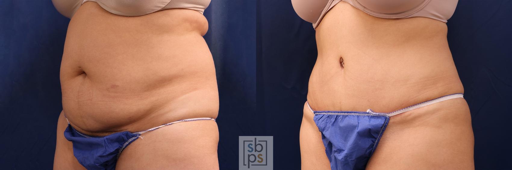 Before & After Liposuction Case 507 Left Oblique View in Torrance, CA