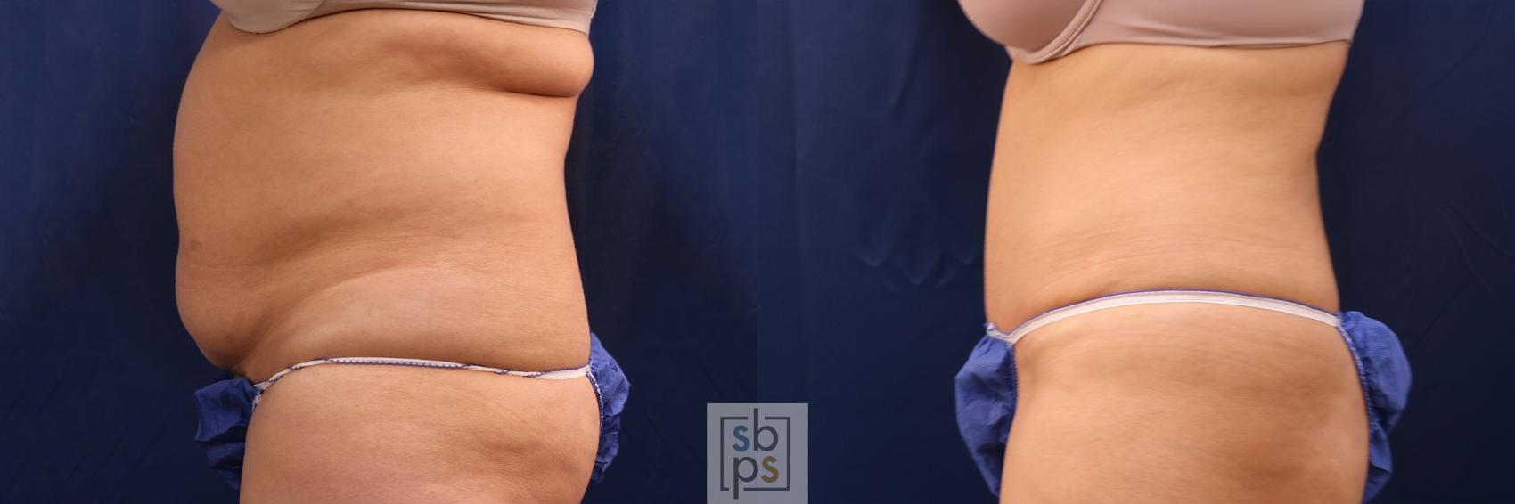 Before & After Liposuction Case 507 Left Side View in Torrance, CA