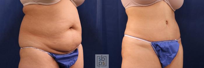 Before & After Liposuction Case 507 Right Oblique View in Torrance, CA