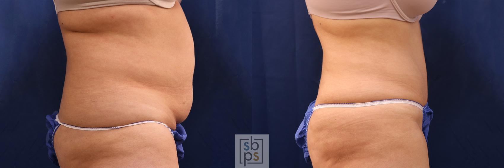 Before & After Liposuction Case 507 Right Side View in Torrance, CA