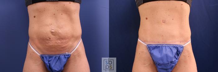 Before & After Tummy Tuck Case 508 Front View in Torrance, CA