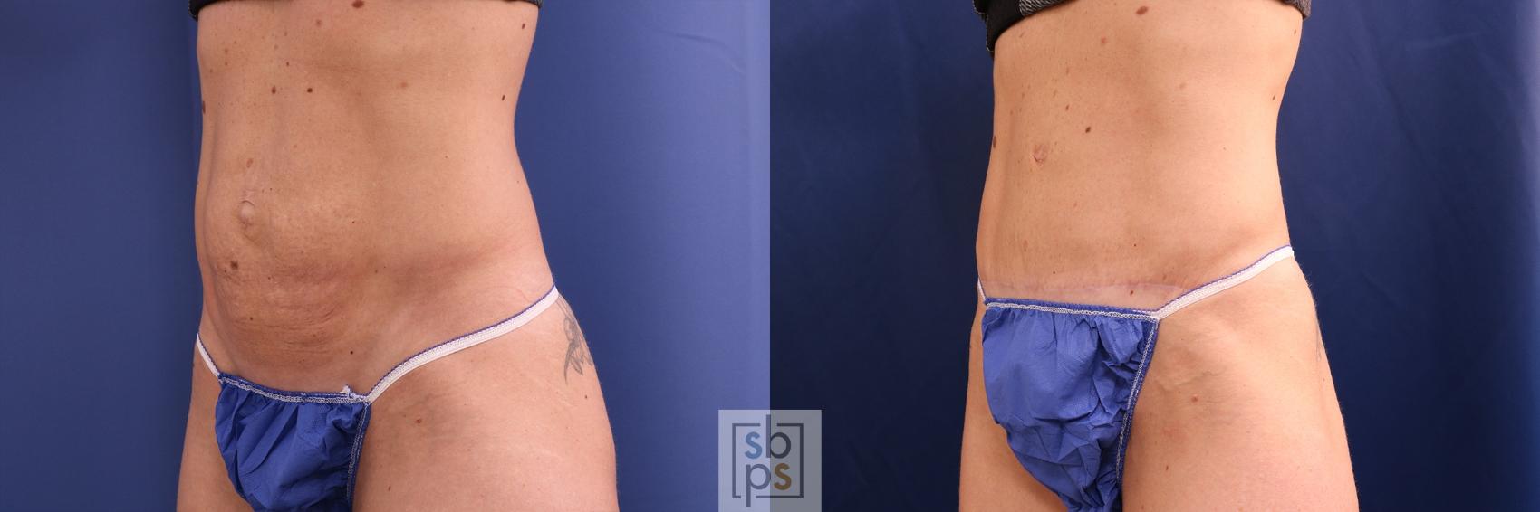 Before & After Tummy Tuck Case 508 Left Oblique View in Torrance, CA
