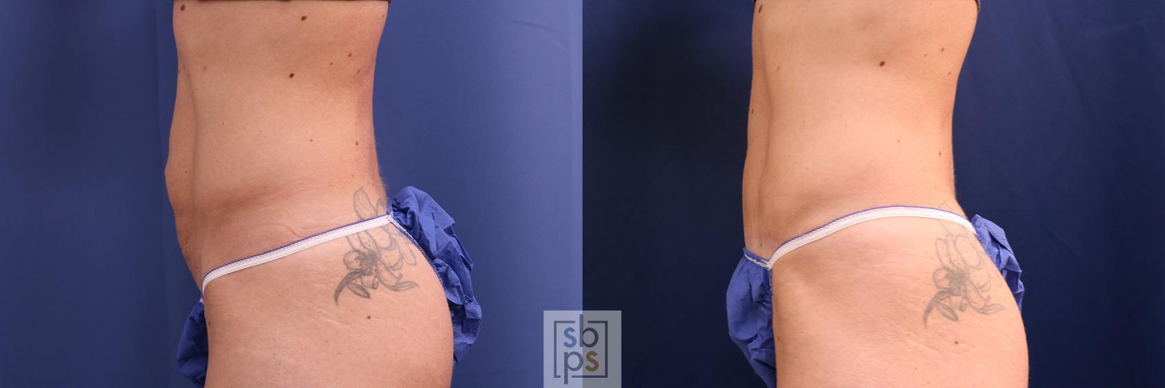 Before & After Tummy Tuck Case 508 Left Side View in Torrance, CA