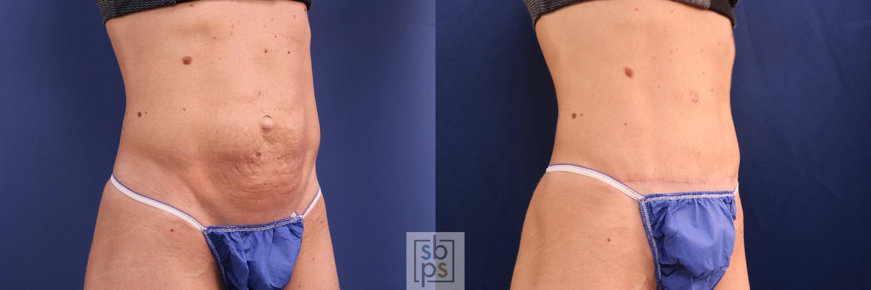 Before & After Tummy Tuck Case 508 Right Oblique View in Torrance, CA