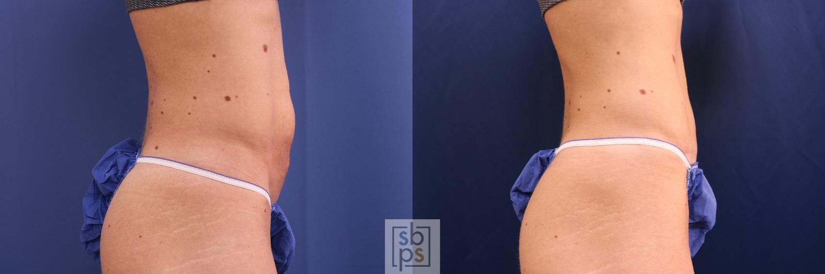 Before & After Tummy Tuck Case 508 Right Side View in Torrance, CA