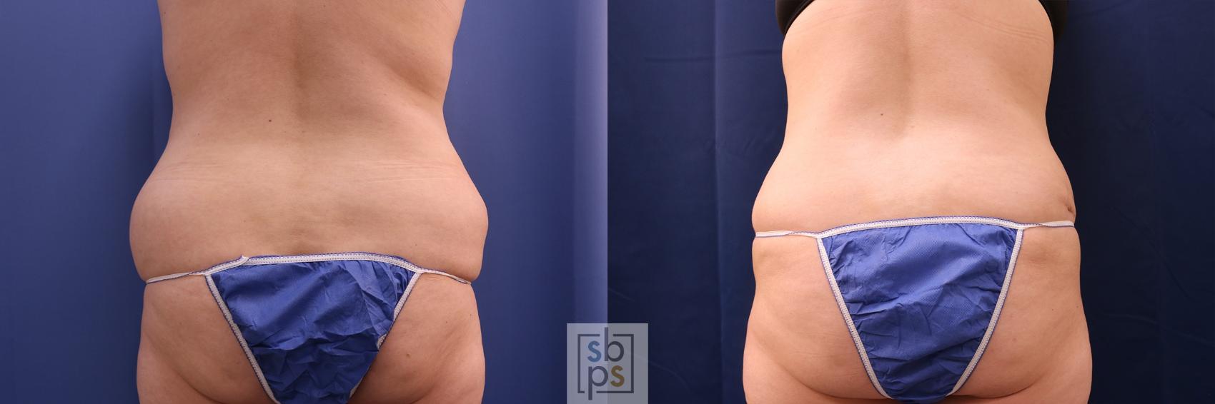 Before & After Liposuction Case 522 Back View in Torrance, CA