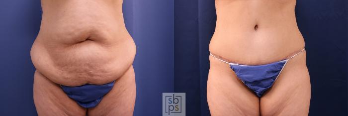 Before & After Tummy Tuck Case 522 Front View in Torrance, CA